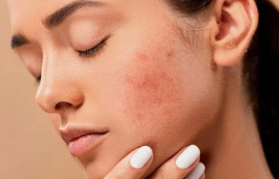 هذه أسباب ظهور البثور على البشرة الجافة.. إليكم الحل صورة رقم 4 هذه أسباب ظهور البثور على البشرة الجافة.. إليكم الحل صورة رقم 4