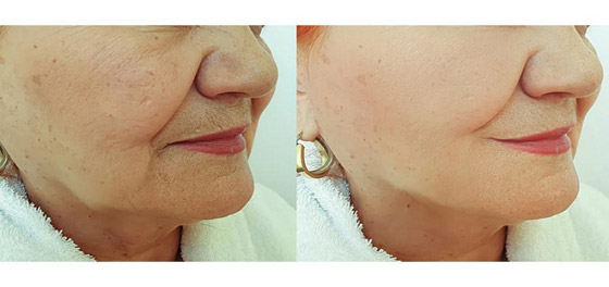 ترهل الجلد.. عالجيه في المنزل بهذه الطرق صورة رقم 2