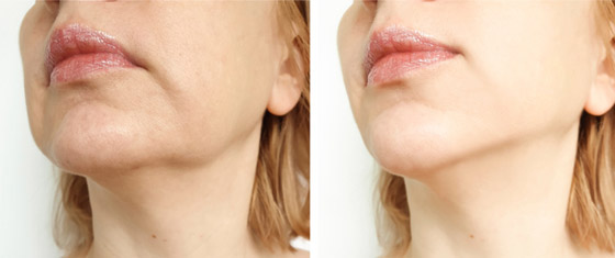 ترهل الجلد.. عالجيه في المنزل بهذه الطرق صورة رقم 8