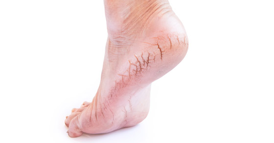 أسباب تشقق جلد القدمين لدى النساء في الصيف.. حلول وعلاجات صورة رقم 5