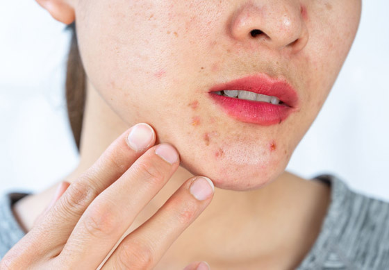 ما هي أسباب ظهور حب الشباب على منطقة الذقن؟ صورة رقم 1 ما هي أسباب ظهور حب الشباب على منطقة الذقن؟ صورة رقم 1