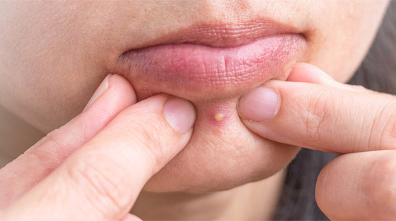 ما هي أسباب ظهور حب الشباب على منطقة الذقن؟ صورة رقم 4 ما هي أسباب ظهور حب الشباب على منطقة الذقن؟ صورة رقم 4