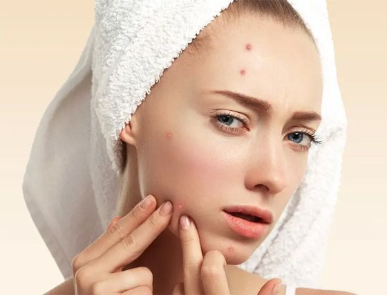 ما هي أسباب ظهور حب الشباب على منطقة الذقن؟ صورة رقم 2 ما هي أسباب ظهور حب الشباب على منطقة الذقن؟ صورة رقم 2