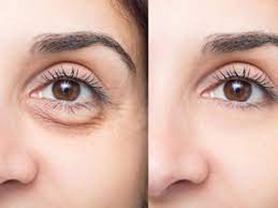 فيلر تحت العينين.. كل ما تحتاجين إلى معرفته عن هذا الإجراء التجميلي صورة رقم 6