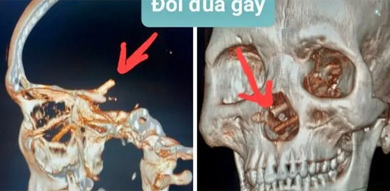 صورة رقم 2 - عيدان تناول طعام اخترقت أنف مريض لجمجمته وظلت 5 أشهر! صور صورة رقم 2 - عيدان تناول طعام اخترقت أنف مريض لجمجمته وظلت 5 أشهر! صور