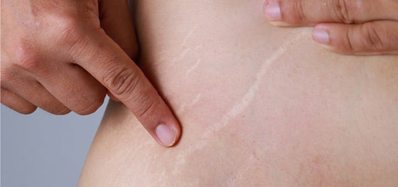 الخطوط البيضاء في الجسم تزعجكِ؟.. اكتشفي طرق علاجها صورة رقم 2