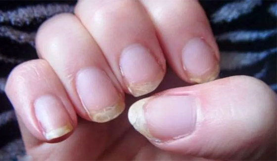 من لون أظافرك.. يمكنك التعرف على حالتك الصحية صورة رقم 3