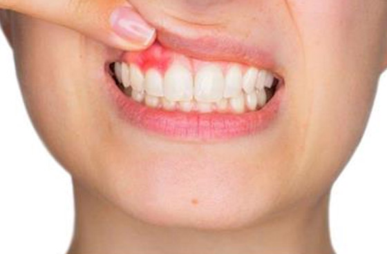 5 عادات شائعة قد تصيبك بأمراض خطيرة.. احذرها صورة رقم 5