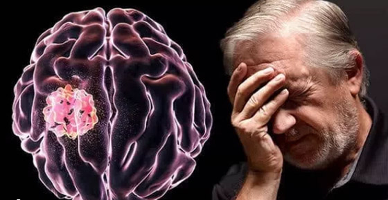  صورة رقم 2 - مش بس الصداع.. 4 علامات تحذيرية مبكرة لأورام المخ لا تتجاهلها