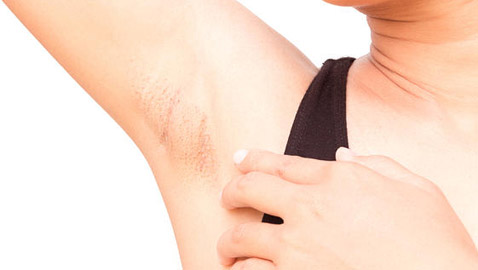 3 علاجات منزلية في 5 دقائق فقط للتخلص من بثور تحت الإبط