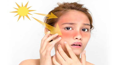 إليكم أفضل ماسك لإزالة آثار حروق الشمس