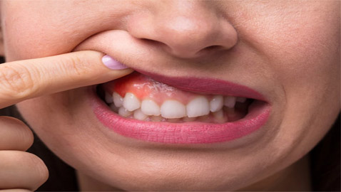 قد تدل على مشكلة صحية خطيرة.. ما أسباب حساسية اللثة وطرق علاجها؟