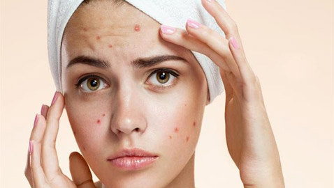 3 نصائح بسيطة وفعالة تبعدك عن كابوس حب الشباب