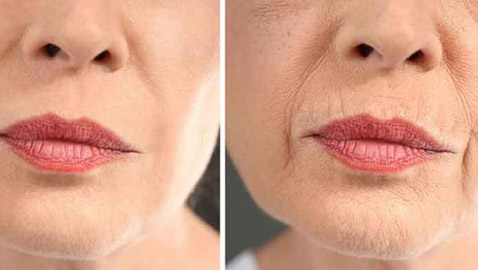 قبل البوتوكس.... نصائح لتخفيف التجاعيد حول الفم