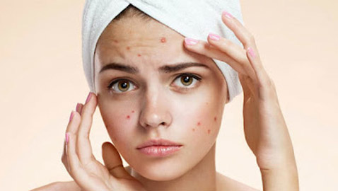 منها معجون الأسنان والملح.. 10 طرق للتخلص من بثور البشرة المفاجئة