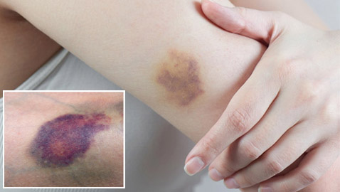 تعاني من الكدمات الزرقاء باستمرار ولا تتذكر السبب؟ قد يشير لحالات صحية خطيرة