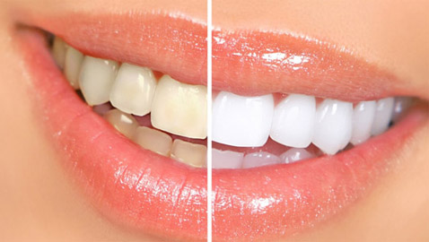 إليكم طرق بسيطة وعلاجات طبيعية تساعدكم على تبييض أسنانكم