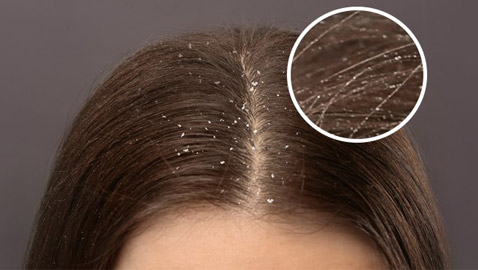 جافة أم دهنية.. أي نوع من القشرة تعانون منه؟ وما علاجها؟