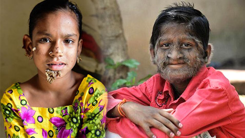 اليكم قائمة بأغرب الأمراض التي تصيب البشر