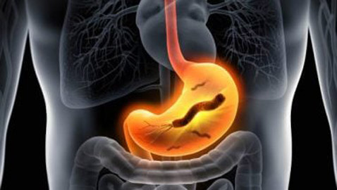 جرثومة المعدة.. أعراضها الصحية والنفسية وعلاجها بالأعشاب