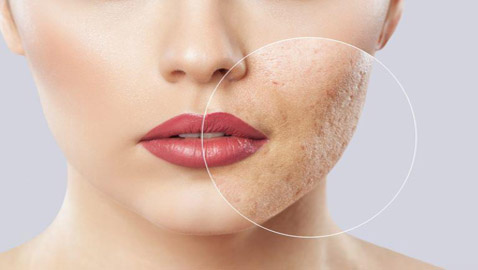 إليكم طرق إزالة حفر الوجه طبيعيا قبل رأس السنة