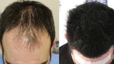 أشياء هامة عليك معرفتها قبل الإقدام على زراعة الشعر