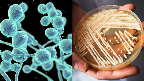 داء فطر البقع البيضاء.. تحذير من بكتيريا نادرة تشكل تهديدا عالميا!