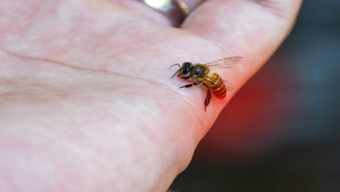 لا تتركها تتهيج وانتبه للحساسية.. علاجات طبية ومنزلية للسعات النحل