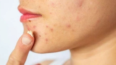 منتجات منزلية لعلاج حب الشباب