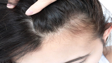 مظهرها يزعجك وتسبب لك الإحراج؟ 8 علاجات طبيعية لفراغات الشعر