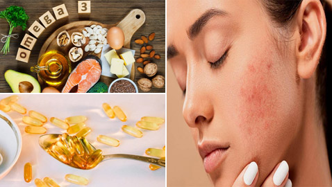 أقوى من المراهم والأدوية.. كيف تتخلص أحماض أوميغا 3 من حب الشباب؟
