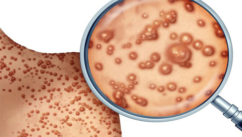 كيف يبدو جدري القردة؟ 6 رسومات تكشف تغييرات الجلد يجب الانتباه إليها