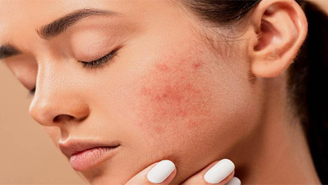 البثور الشائعة تصيب الكثيرين.. 6 أنواع والحل مختلف لكل منها