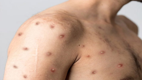 وسط تزايد إصابات جدري القرود.. قرار مرتقب للصحة العالمية