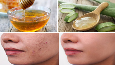 هكذا يمكنكم إزالة آثار الحبوب من البشرة باستخدام مكونات طبيعية