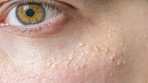 هكذا تتخلصون من الزيوان الأبيض الذي يغزو البشرة