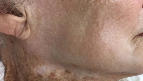 صورة واحدة تكشف أهمية وضع الواقي من الشمس على الوجه والعنق