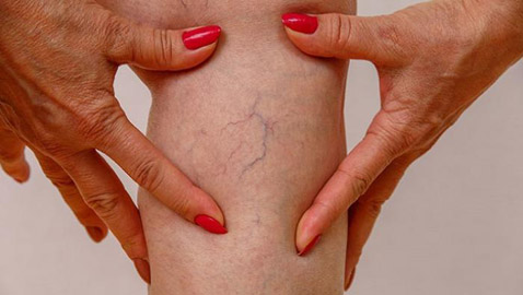 الأوردة العنكبوتية تفسد جمال سيقانك؟ هكذا تتخلصين منها