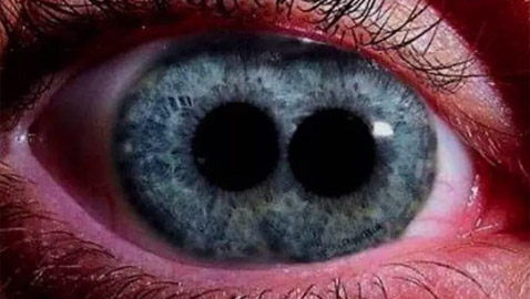 حدقتان في عين واحدة! تعرفوا إلى متلازمة 