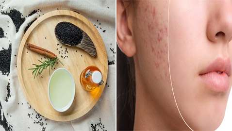 5 علاجات طبيعية للتخلص من ندوب حب الشباب