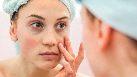 الهالات الصفراء تحت العينين.. الأسباب والحلول