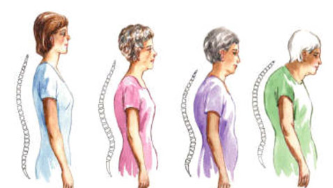 هشاشة العظام ..أسبابها وطرق مكافحتها